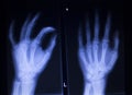 X-ray orthopedics Traumatology scan of hand finger injury Royalty Free Stock Photo