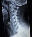 X-ray orthopedics Traumatology scan of neck injury Royalty Free Stock Photo