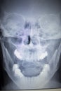 X-ray orthopedics Traumatology scan nose injury breathing Royalty Free Stock Photo