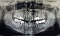 Orthopantomography of an adult patient, dentistry