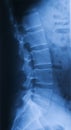 X ray of pars lumbalis lateral Royalty Free Stock Photo