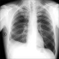 X-ray the patient with the disease of pleurisy. The inflammation around the lungs.