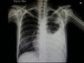 x ray of patient with pneumonia and left plural effusion