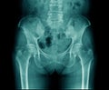 X-ray pelvic bone and part of lumbar bone with hip joint in blue tone