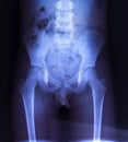 X-ray of the pelvic bones of the child. Royalty Free Stock Photo