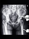 X-ray of pelvic with external fixation device Royalty Free Stock Photo