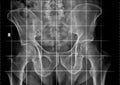 X-ray of a pelvic obliquity