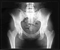 X-ray of the pelvis