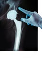 X-ray of the pelvis Endoprosthesis glove pointed Royalty Free Stock Photo