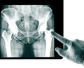 X-ray of the pelvis Endoprosthesis Royalty Free Stock Photo