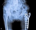 X Ray of pelvis with fracture femur bone