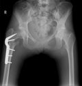 X-ray of the pelvis with fracture of the neck of the thigh. With subsequent fixation of metal