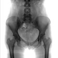 X-ray of the pelvis and the lumbosacral spine. Spina bifida S1. Negative.