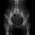 X-ray of the pelvis and the lumbosacral spine. Spina bifida S1.