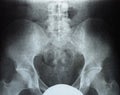 X-ray of the pelvis and sacrum. X-ray