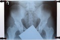 X-ray of the pelvis and sacrum. X-ray