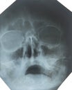 X-ray of the sinuses of the nose