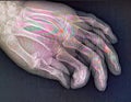 Left hand Color Radiography Royalty Free Stock Photo
