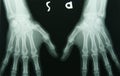 X-ray photo of hands