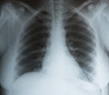 X-ray photo of a human adult chest with infected lungs with Covid-19