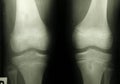 X-ray photo of human knee caps Royalty Free Stock Photo