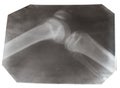 X-ray photo of human knee joint isolated Royalty Free Stock Photo