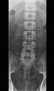 x-ray photo of human lumbar spine, front view Royalty Free Stock Photo