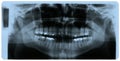 X-ray photo of human teeth Royalty Free Stock Photo