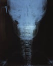 X-ray photo of the neck area of an adult. Royalty Free Stock Photo