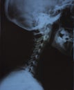 X-ray photo of the neck area of an adult. Royalty Free Stock Photo