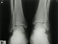 X-ray photo of person's ankles Royalty Free Stock Photo