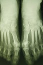 X-ray photo of person's feet