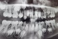 X-RAY PICTURE OF DAIRY AND NEW CHILDRENS TEETH