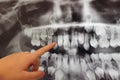X-RAY PICTURE OF DAIRY AND NEW CHILDRENS TEETH