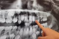 X-RAY PICTURE OF DAIRY AND NEW CHILDRENS TEETH