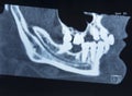 X-ray picture of the female jaw of a man with the absence of several teeth