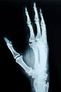 X-ray picture of human hands.