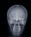 X-ray picture:human head