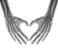 X-ray picture - Human palms