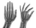 X-ray picture - Human palms