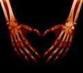 X-ray picture - Human palms