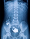X-ray picture of the intestine with foreign bodies