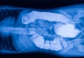 X-ray picture of the intestine with foreign bodies