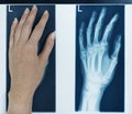 X-ray picture left hand Royalty Free Stock Photo