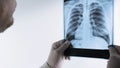 X-ray picture of a man in the hands of a doctor  a medical worker examines an X-ray of the lungs. Pneumonia Royalty Free Stock Photo