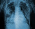 X-ray picture of a patient with lung disease Royalty Free Stock Photo