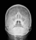 X-ray picture - Sinus Royalty Free Stock Photo