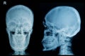 X-ray picture of the skull injury