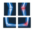X-ray Pictures Of Elbows And Knees Are Diagnostic Images That Reveal The Internal Structures, Vector Set Royalty Free Stock Photo