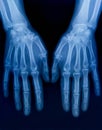 X-ray plate of the bones of the both human hands Royalty Free Stock Photo